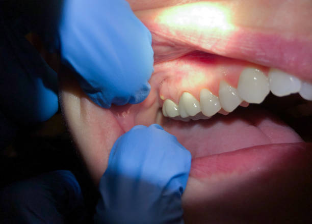 Best Emergency Treatment for Oral Infections in Haverhill, FL